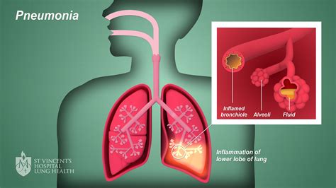 Can You Travel with Pneumonia? Exploring the Boundaries of Health and Adventure